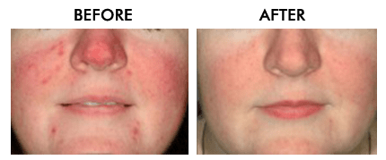 Microneedling with PRP Fort Lauderdale