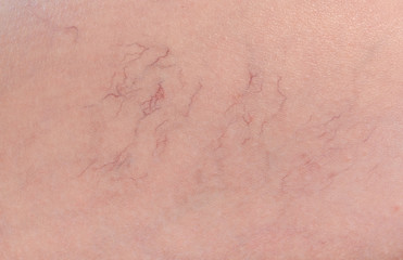 Spider Vein Removal in Fort Lauderdale
